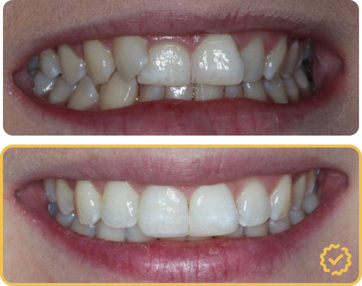 Clear Aligners Before After Comparison